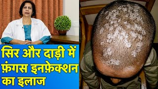 सिर और दाड़ी के फ़ंगस इनफ़ेक्शन का इलाज  Treatment of Fungal Infections In Beard amp Scalp [upl. by Eyram]