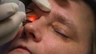 Xanthelasma laser treatment [upl. by Nabal]