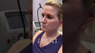 Natural Results  Mini Facelift with Neck Lift  Before amp After [upl. by Richie]