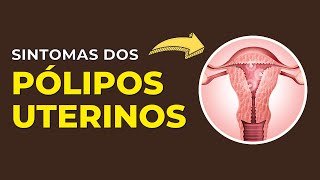 Quais os sintomas do pólipo uterino Pólipo vira câncer [upl. by Nnave275]