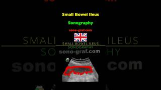 Sonography  Small Bowel Ileus [upl. by Elenore80]