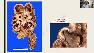 Hydronephrosis and Renal calculi  Renal Pathology RATS in Pathology [upl. by Yalahs]