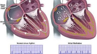 Atrial Fibrillation [upl. by Toni482]