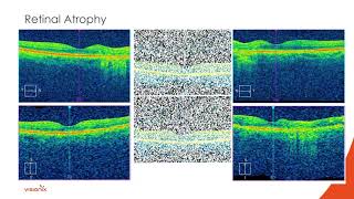 Interpreting Retinal OCTs amp Introducing OCTAngiography Part 1 with Dr Nathan Lighthizer [upl. by Rebmaed]