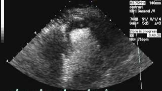 Apical Thrombus [upl. by Iveel]