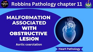 Malformations Associated With Obstructive Lesions Aortic Coarctation pathology robbins heart [upl. by Iong]