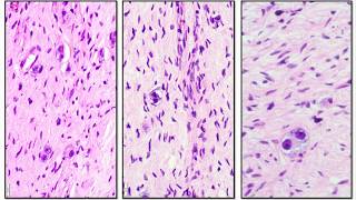 Neuroblastoma and Ganglioneuroma  Adventures in Neuropathology [upl. by Chemush]