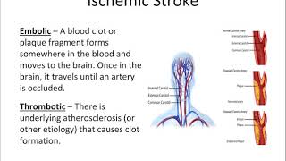 Carotid Artery Disease Unit 2 [upl. by Hesther]