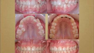 Cas traités en orthodontie orthodontistes Lemaymov [upl. by Dub389]