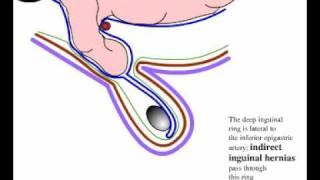 Direct and indirect inguinal hernia [upl. by Loesceke]