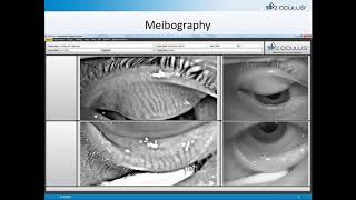 Online Seminar Chad Overman Tips for Practice Building with Your Keratograph® 5M [upl. by Juxon]