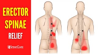 How to Fix Erector Spinae Pain FOR GOOD [upl. by Atinram251]