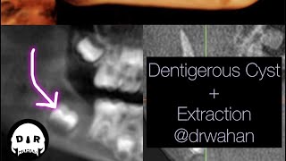 Dentigerous Cyst Removal with Extraction of Involved Impacted Molar drwahan [upl. by Nicodemus]