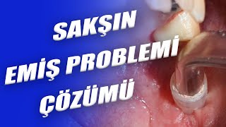 Sakşın Seçimi Ve Emiş Problemi Çözümü [upl. by Einnus]