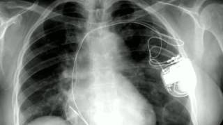 Pacemaker and defibrillator [upl. by Kinnie]