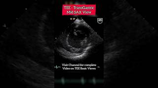 Trans Esophageal Echocardiogram Transgastric SAX View echocardiography heart shorts [upl. by Celinka480]