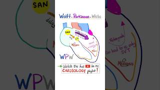 Cardiac Arrhythmia WolffParkinson White WPW Syndrome science cardio nurse doctor mbbs [upl. by Fineberg417]