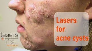 Treating acne cysts [upl. by Retswerb889]