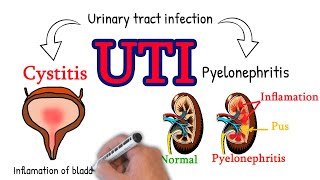 Cystitis  made simply UTI Cystitis vs pyelonephritis [upl. by Grekin714]