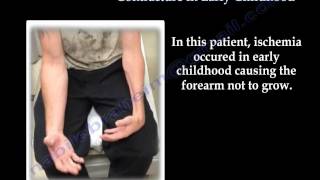 Volkmanns Ischemic Contracture Early Childhood  Everything You Need To Know  Dr Nabil Ebraheim [upl. by Alaine]