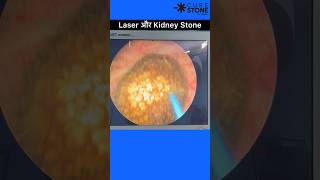 Kidney stone treatment using laser  RIRS  Retrograde intrarenal surgery shorts [upl. by Kilah]