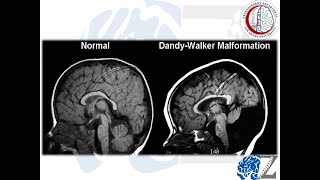 DandyWalker Malformation متلازمة دانديووكر [upl. by Alessig]