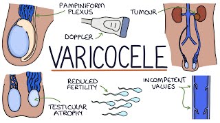 Varicoceles [upl. by Eirallih]