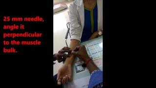 Dry Needling Flexor Pollicis longus [upl. by Kawai]