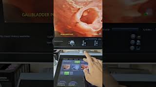 Gallbladder Polyp 3d Ultrasound [upl. by Oine]