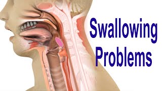 Swallowing Problems or Dysphagia Top 4 Possible Causes Including Cricopharyngeal Dysfunction CPD [upl. by Rask]