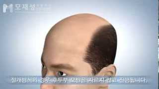 절개 모발이식 수술과정FUSS Hair Transplantation [upl. by Marshall]