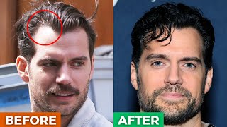 5 BRILLIANT Hairstyles To HIDE A Receding HairlineWidows Peak [upl. by Mel]