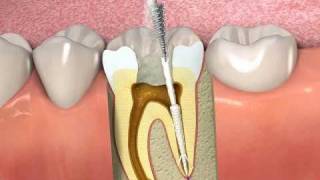 ProPoint How to obturate a root canal with SmartSeal [upl. by Stubstad]