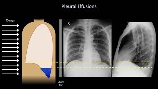 How to Interpret a Chest XRay Lesson 6  Diaphragm and Pleura [upl. by Baudelaire]