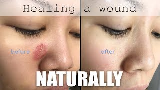 Healing a face wound naturally [upl. by Lelah518]