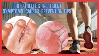 Foot athlete’s treatment symptoms causes prevention tips ytshorts HEALTH [upl. by Yaral170]