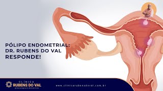 Pólipo endometrial Dr Rubens do Val responde  Clínica Rubens do Val CRM 58764 [upl. by Calesta91]