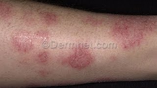 Varicose Eczema  7 Facts About Varicose Eczema You Must Know [upl. by Howland722]