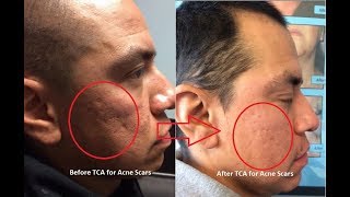 Acne scar treatment and acne scar removal in Los Angeles using TCA chemical peel [upl. by Andreas]