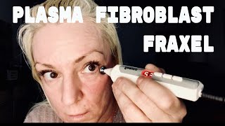 PLASMA FIBROBLAST FRAXEL  At home skin tightening [upl. by Mariandi]