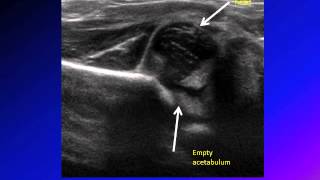 DDH developmental dysplasia of hip congenital hip dislocation CHD [upl. by Letnuahs]