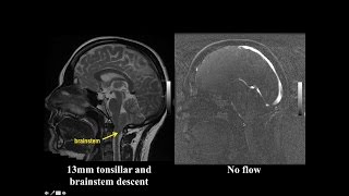 Cine MRI for Chiari I Malformation [upl. by Nauwtna]