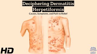 Dermatitis Herpetiformis Explained Symptoms Triggers and Relief [upl. by Attenreb]