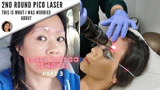 Another Microblading Removal Session What worked and What didntPart 3 [upl. by Anyal]