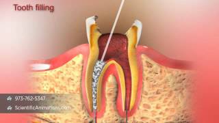 Root Canal Treatment [upl. by Delogu]