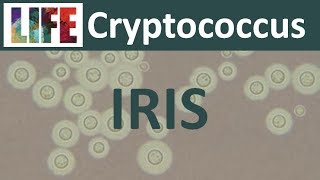 Cryptococcal IRIS [upl. by Llesirg]