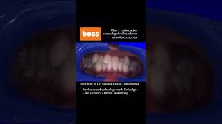 Invisalign makeover for Class 3 crossbite  Before and after time lapse video [upl. by Okia]