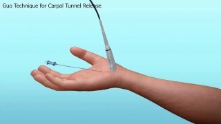 Carpal Tunnel Release [upl. by Eessej]