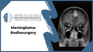 Meningioma Radiosurgery [upl. by Andaira952]