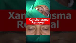 XANTHELASMA Removal Treatment At Shobhit Aesthetics [upl. by Laehcim]